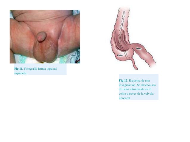 A entrada da valvula ileocecal incompetente
