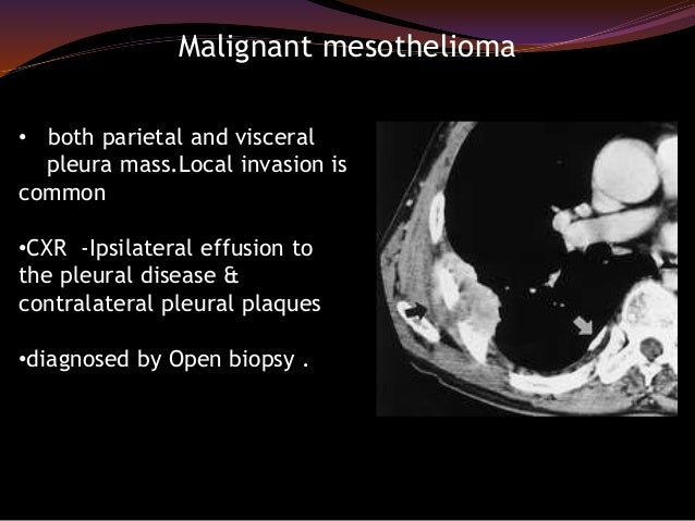 Human malignant pleural mesothelioma law corporations in quezon town hiring
