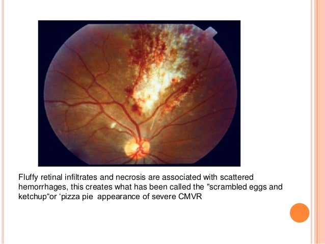 Ocular manifestation of hiv Ocular manifestation of hiv