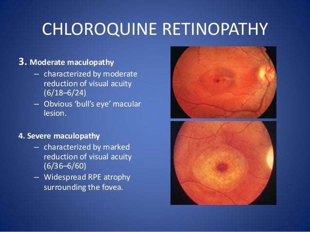 Chloroquine Side Effects Mnemonic