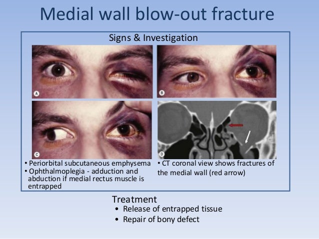 blowout fracture