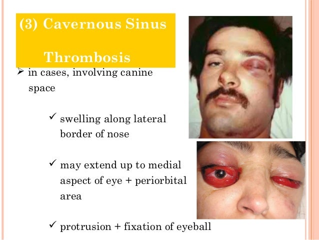 cavernous sinus thrombosis