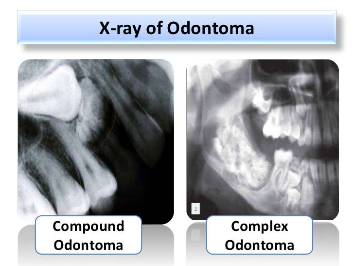 Odontogenic tumors