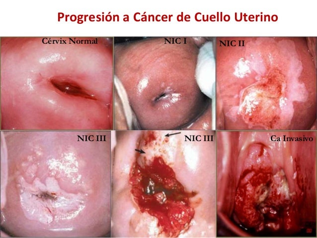 Resultado de imagem para cancer do colo do utero