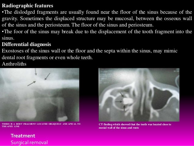 reasons continual sinusitis