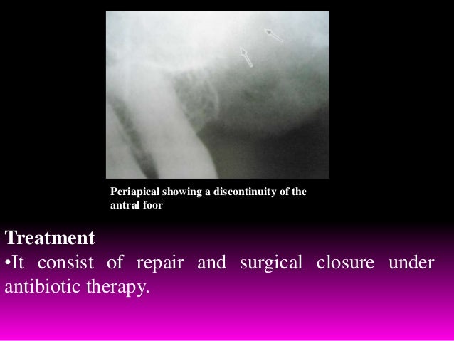 unilateral maxillary sinus mucocele Mucocele of maxillary sinus surgical treatment of unilateral exophthalmos due to maxillary brown tumor mimicking maxillary sinus mucocele as the first. unilateral maxillary sinus mucocele Mucocele of maxillary sinus surgical treatment of unilateral exophthalmos due to maxillary brown tumor mimicking maxillary sinus mucocele as the first.