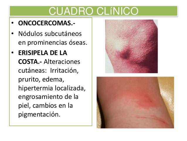 Los modos el tratamiento de la psoriasis
