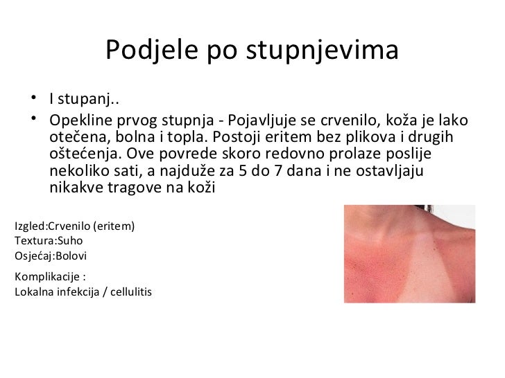 Opekotine
