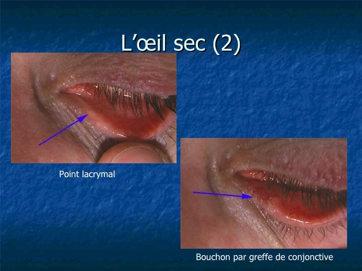 Le massage enlever les rides sous les yeux
