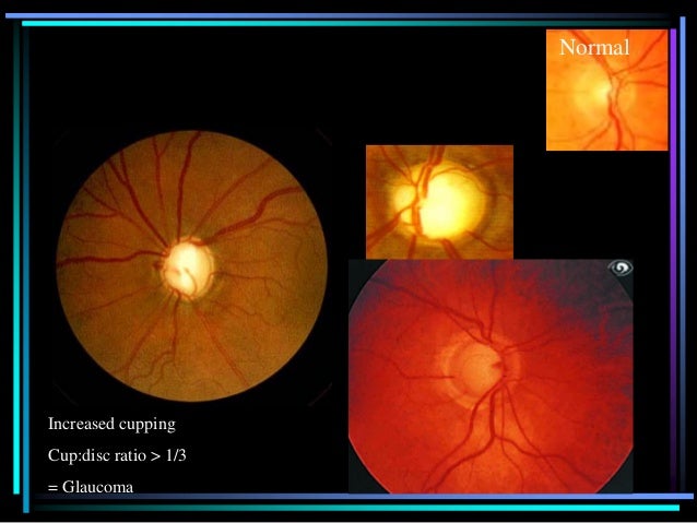 glaucoma findings on fundoscopic exam