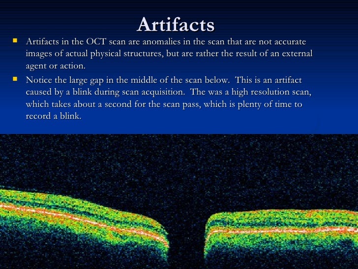 Optical Coherence Tomography principle and uses in ophthalmology