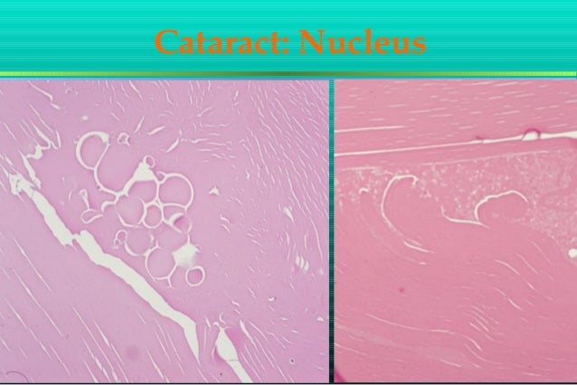 Pigmentosa Retinitis Viagra