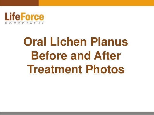 lichen planus treatment
