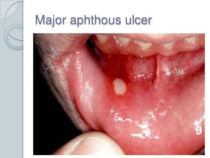 The mouth pictures herpes in The mouth pictures herpes in