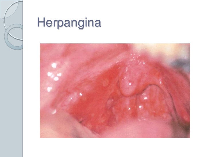 Herpangina, acute koorts | Mens en Gezondheid: Ziekten