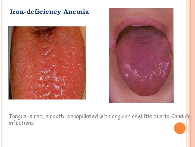 Iron deficiency anemia: MedlinePlus Medical Encyclopedia