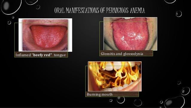 Angular Cheilitis Treatment » How to Cure Angular Cheilitis