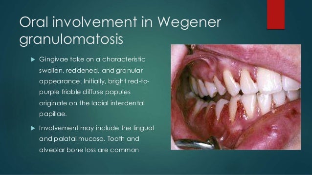 Systemic Diseases Caused by Oral Infection