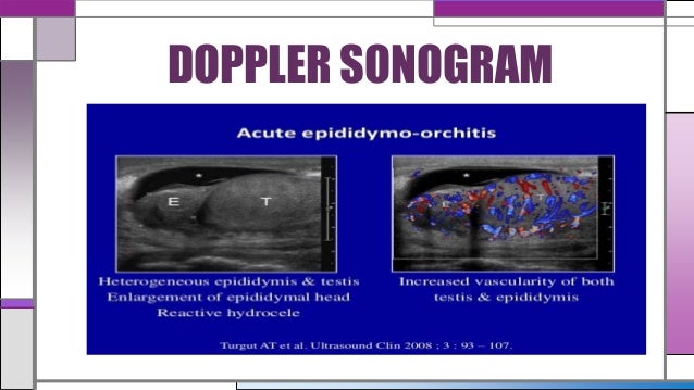 Orchitis & epididymitis