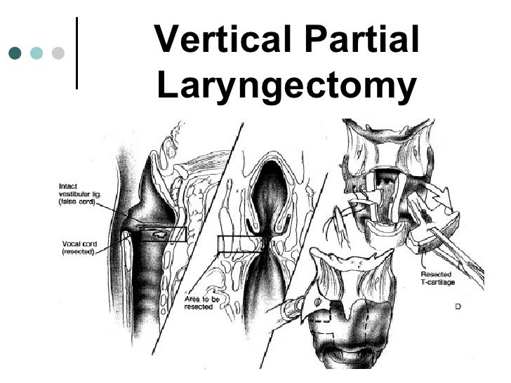 Organ Preservation Surgery For Laryngeal Cancer