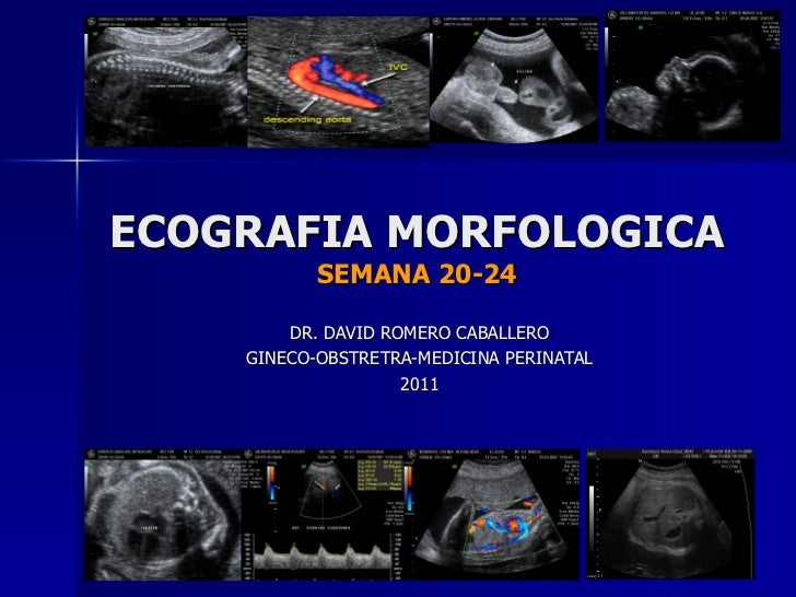 ECOGRAFIA DE LA SEMANA 20 ecografia de la semana 20:
