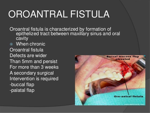 Exceptional medication for sinus drainage and headache pilonidal cyst domestic treatment pain