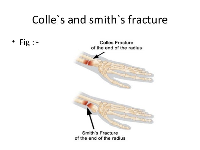 colles smith fracture colles smith fracture