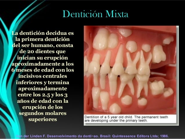 Ortodoncia analsiis de denticion mixta