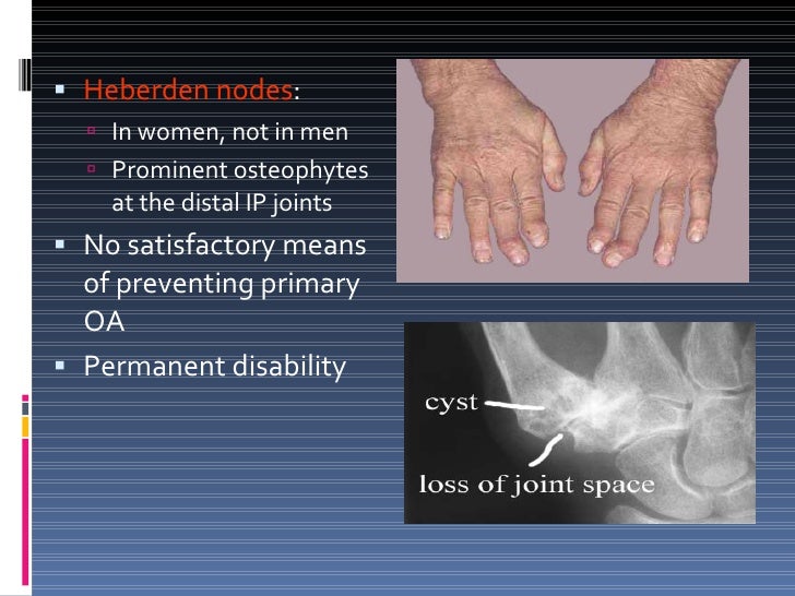 Osteoarthritis