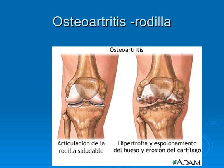 Osteoartritis rodilla