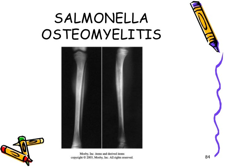 Osteomyelitis
