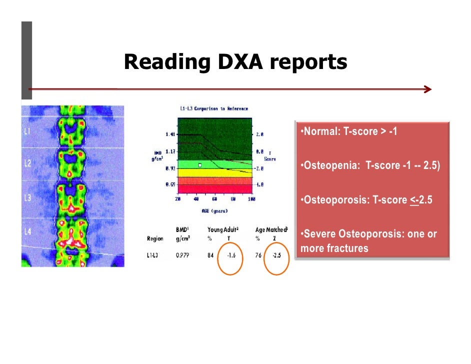 Osteoporosis osteoporosis