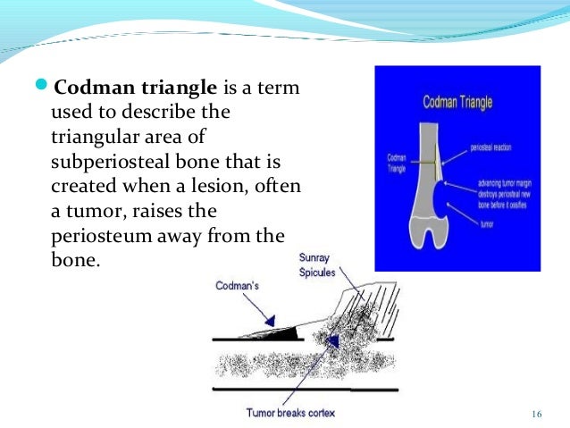 Pics For > Osteosarcoma Codmans Triangle