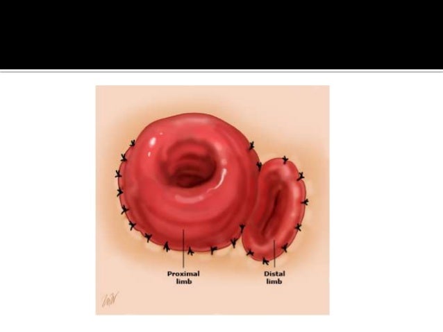 ostomias