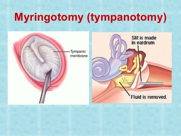 Otitis externa and media