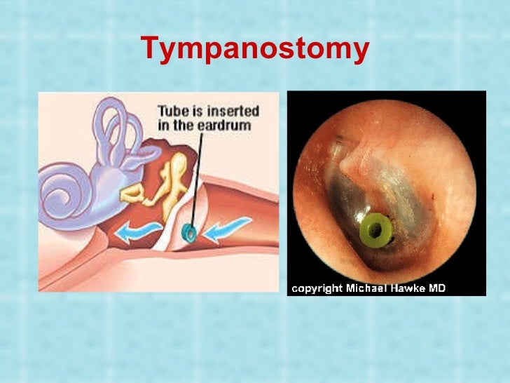 Otitis externa and media