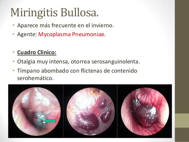 Otitis externa Otitis externa