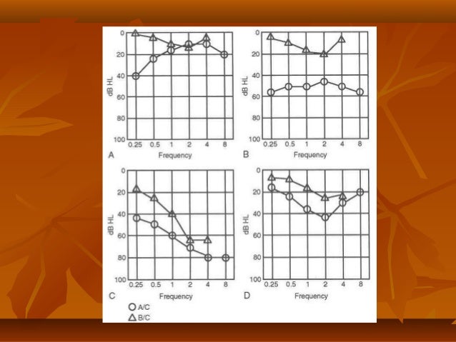 Natural Treatment For Otosclerosis Natural Treatment For Otosclerosis