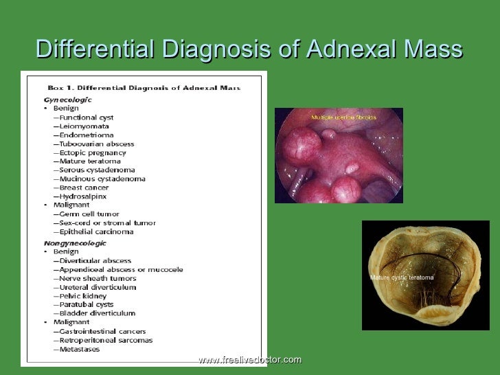 View Ovarian Cancer Adnexal Mass Ultrasound PNG