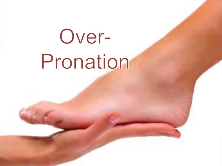 Over-pronation Hyperpronation