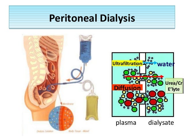 Southmead clinic dialysis unit fresenius dialysis education