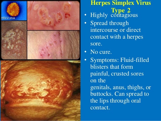 Mild Herpes Photographs - herpes-coldsores.com