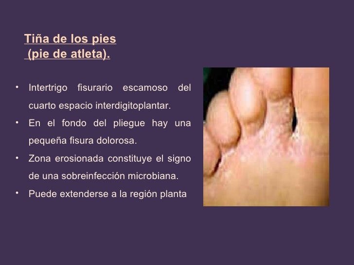 Atopichesky la dermatitis en la piel alrededor de los ojos