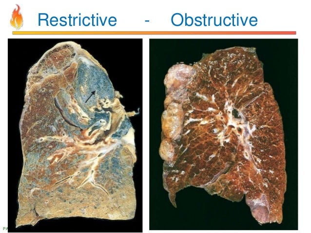 what's mesothelioma lawyers
