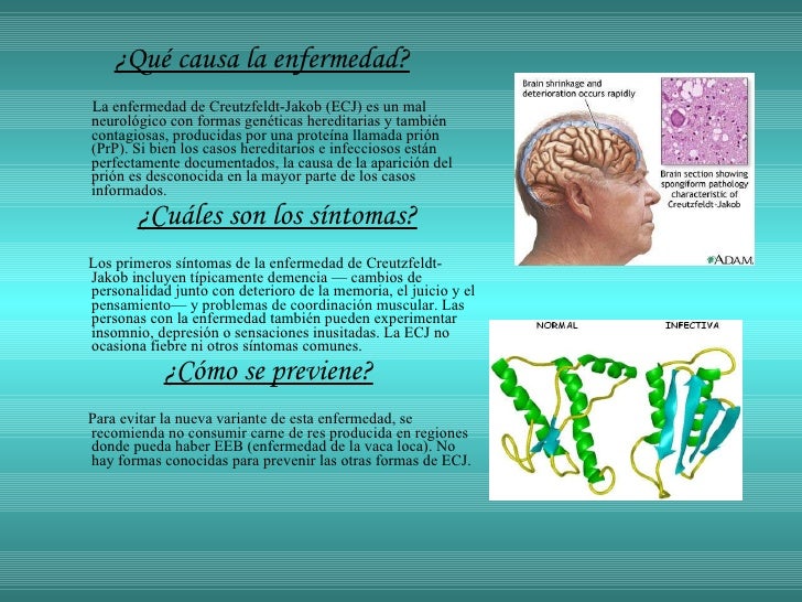 ENFERMEDAD DE CREUTZFELD JAKOB