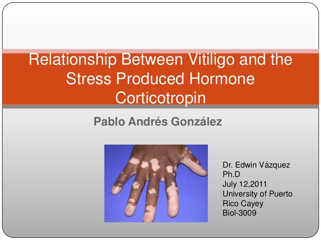 Vitiligo Treatment Time : Vitiligo Clinical Features And Its Treatments