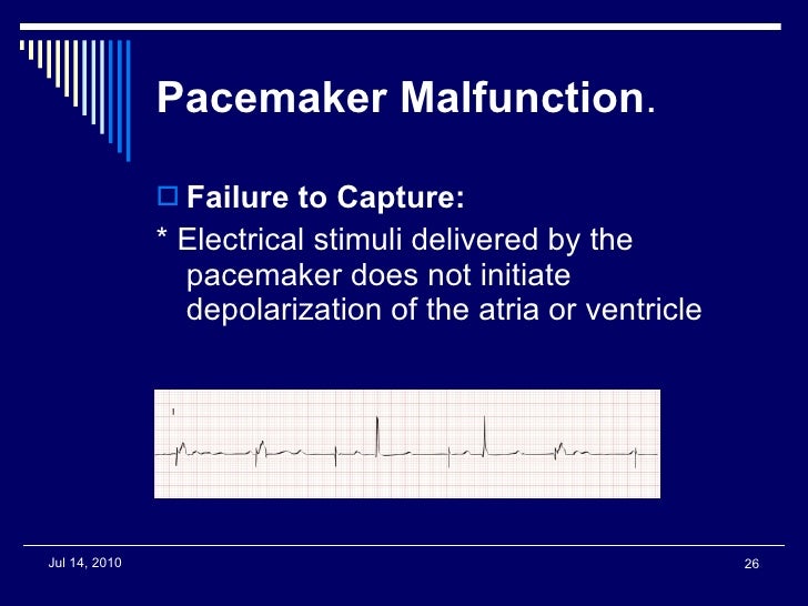 Pacer ppt