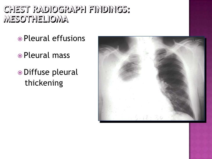 malignant mesothelioma cxr