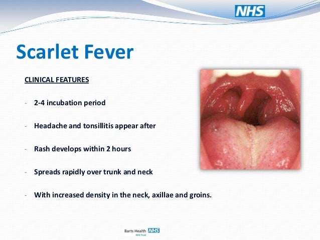 Scarlet fever - NHS Choices