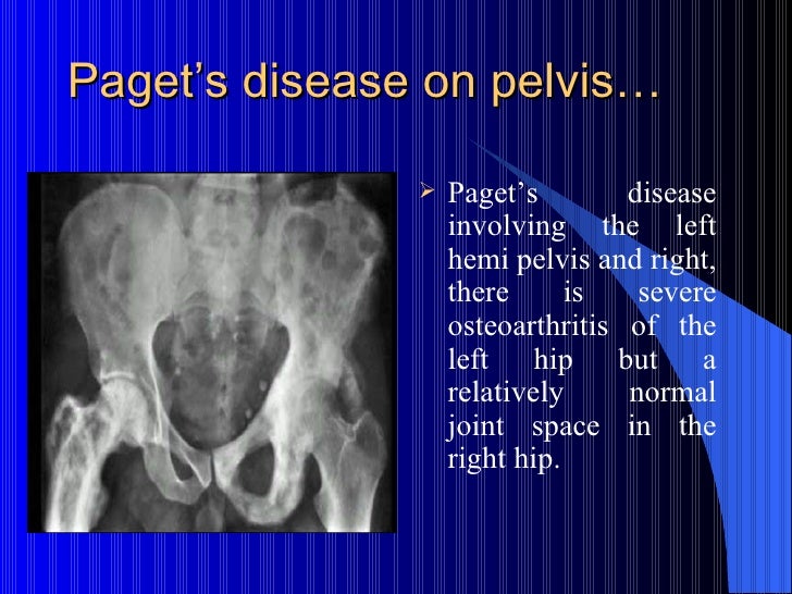 paget's disease